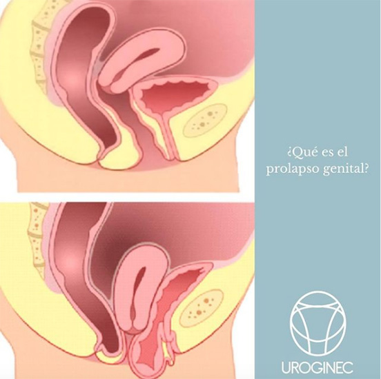 Uroginec Uroginecologia en La Guia Esquel
